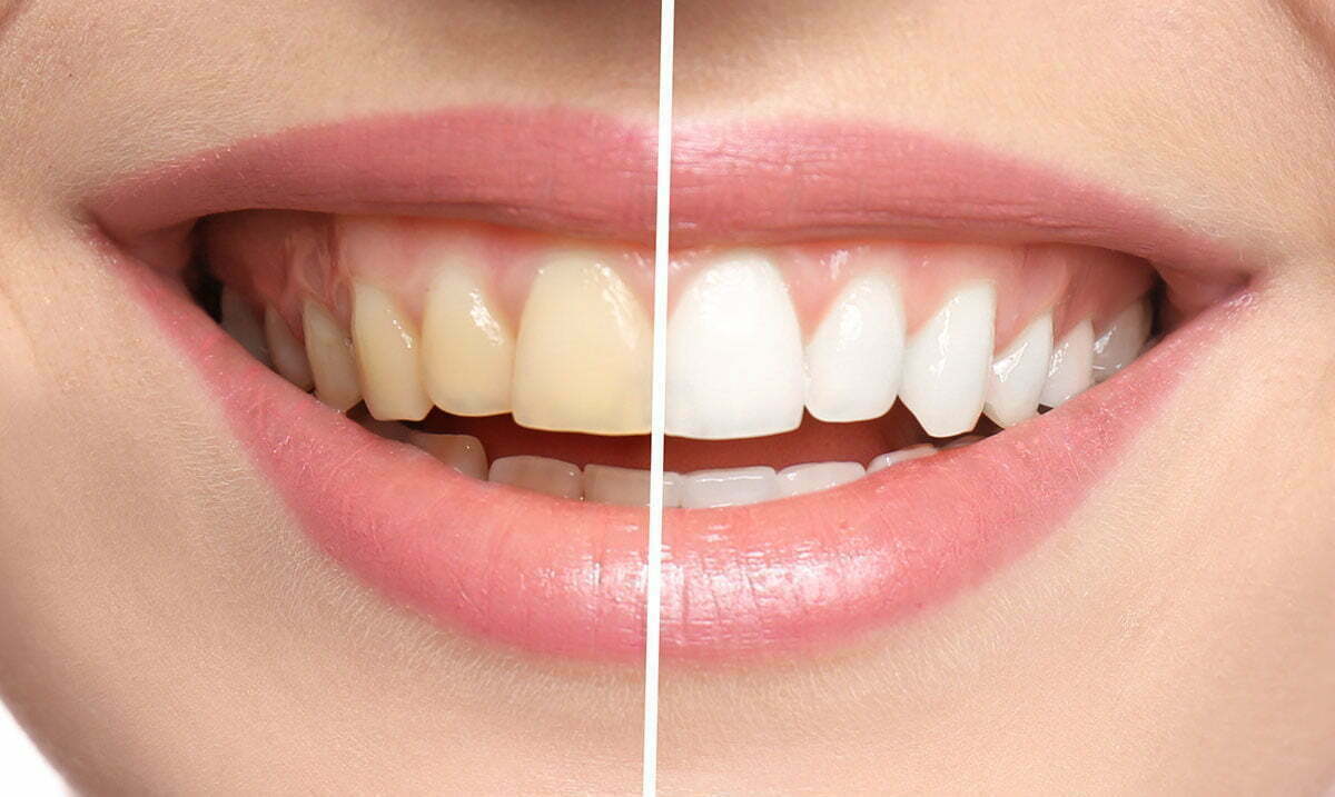 Smiling woman before and after teeth whitening procedure, closeu