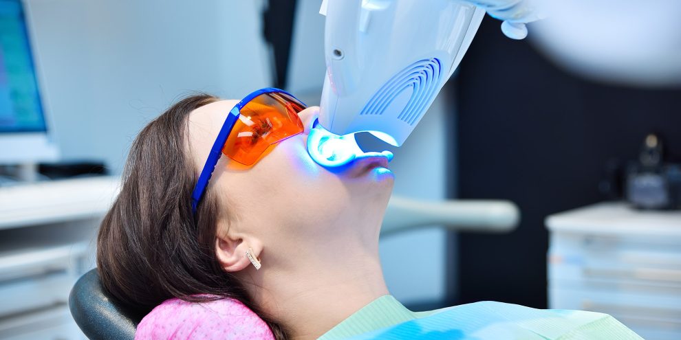 Home Bleachng, In-Office Bleaching, Power Bleaching in Mainz